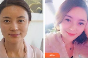 杭州港麗醫(yī)療美容診所童佳奇整形價(jià)格表附切開雙眼皮案例展示