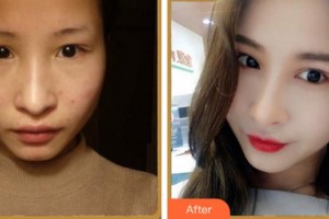 寧波協(xié)和儷人醫(yī)療美容門診部姜宇祿整形價(jià)格表附眼部綜合案例展示