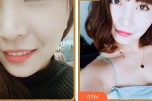 寧波珈禾整形?？漆t(yī)院金正旺整形價(jià)格表附眼部綜合案例展示