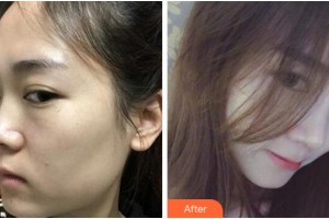 寧波珈禾整形?？漆t(yī)院鮑海萍整形價(jià)格表附膨體隆鼻案例展示