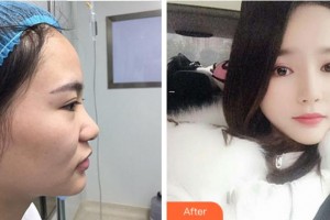 寧波珈禾整形專科醫(yī)院龔濤整形價(jià)格表附鼻部綜合案例展示