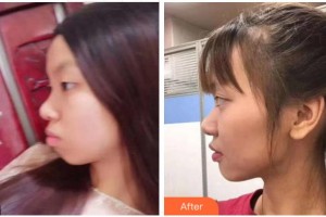 寧波珈禾整形?？漆t(yī)院王昊整形價(jià)格表附金屬托槽矯正案例展示