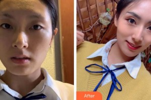 寧波尚麗整形美容醫(yī)院趙其中整形價(jià)格表附埋線提升案例展示