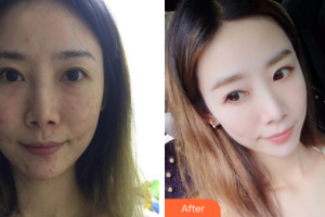 深圳美源醫(yī)療美容門診部劉金祝整形價格表附去痘印痘坑案例展示