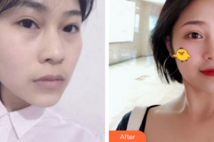 深圳博愛醫(yī)院整形美容中心賀海風整形價格表附埋線提升案例展示