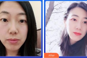 寧波和平博悅美容醫(yī)院金式倫整形價(jià)格表附切開雙眼皮案例展示