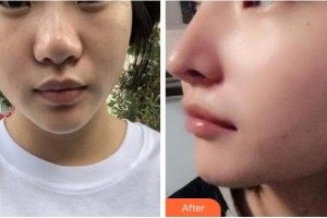 寧波壬美醫(yī)療美容醫(yī)院趙又萱整形價(jià)格表附鼻部綜合案例展示