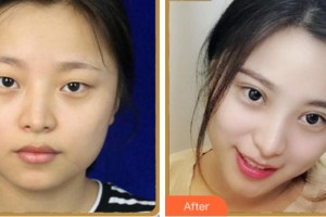 寧波尚麗整形美容醫(yī)院姜昌均整形價格表附眼部綜合案例展示