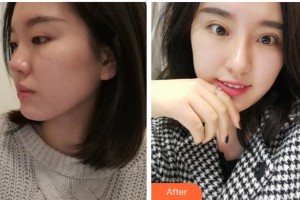 寧波尚麗整形美容醫(yī)院喻正虹整形價格表附眼部綜合案例展示