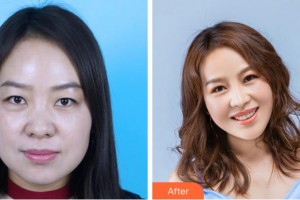 寧波尚麗整形美容醫(yī)院金弘烈整形價格表附膨體隆鼻案例展示