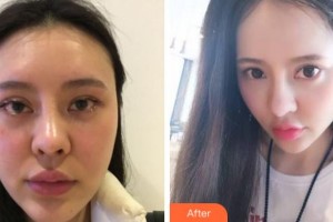 寧波美苑醫(yī)療美容醫(yī)院馬肖琳整形價格表附埋線提升案例展示