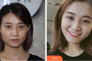 寧波孫敏醫(yī)療美容診所孫敏整形價格表附埋線提升案例展示