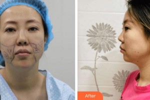 寧波大學(xué)醫(yī)學(xué)院附屬醫(yī)院整形外科任森洋整形價格表附埋線提升案例展示