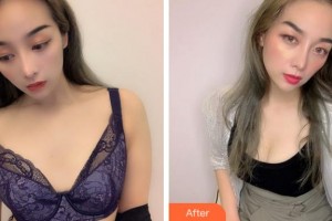 寧波珈禾整形專科醫(yī)院陳樂琴整形價格表附自體脂肪隆胸案例展示