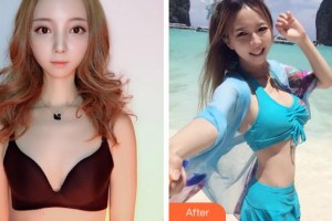 寧波珈禾整形專科醫(yī)院雷中元整形價格表附自體脂肪隆胸案例展示