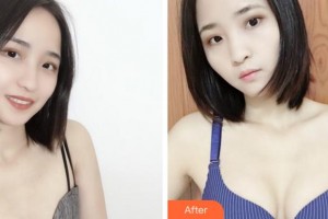 寧波珈禾整形專科醫(yī)院鄧小榮整形價格表附自體脂肪隆胸案例展示