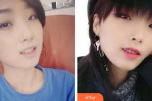 寧波珈禾整形專科醫(yī)院鮑琴兒整形價格表附金屬托槽矯正案例展示