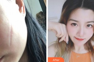 寧波市李惠利醫(yī)院燒傷整形外科金麗華整形價格表附手術(shù)祛疤案例展示