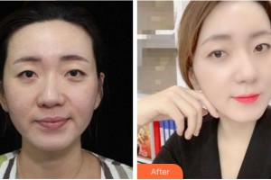 寧波市第二醫(yī)院整形美容外科馬越波整形價格表附熱拉提案例展示