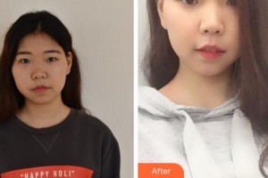 寧波鄔立新醫(yī)療美容診所鄔立新整形價格表附激光祛斑案例展示