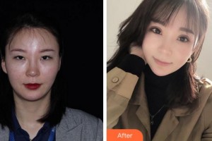 寧波美仁整形美容醫(yī)院李英大整形價格表附眼部綜合案例展示