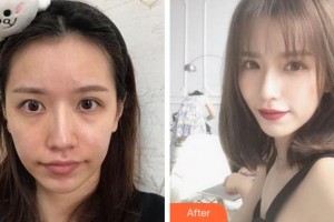 寧波協(xié)和儷人醫(yī)療美容門診部范軍燕整形價格表附埋線提升案例展示