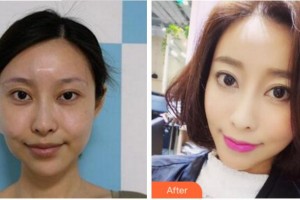 寧波尚麗整形美容醫(yī)院李凖馥整形價格表附埋線提升案例展示