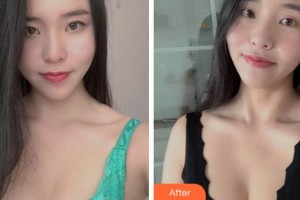 寧波陳標(biāo)新整形美容醫(yī)院催恒碩整形價格表附自體脂肪隆胸案例展示