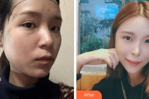 寧波陳標(biāo)新整形美容醫(yī)院金明哲整形價格表附種植發(fā)際線案例展示