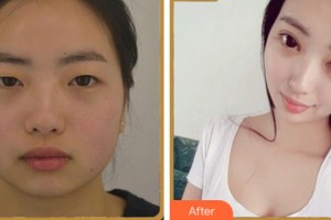 寧波陳標(biāo)新整形美容醫(yī)院白惠媛整形價格表附眼部綜合案例展示