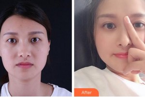 寧波初美醫(yī)療美容診所盧燕明整形價格表附眼部綜合案例展示