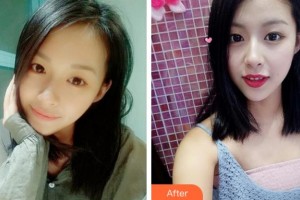 寧波明州醫(yī)院整形美容中心林士隆整形價格表附眼部綜合案例展示