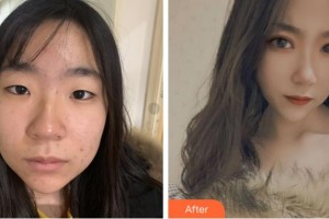 寧波明州醫(yī)院整形美容中心高文彬整形價格表附埋線雙眼皮案例展示