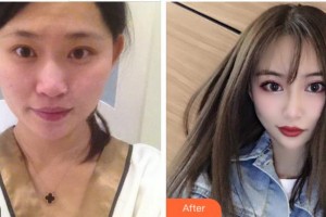 寧波明州醫(yī)院整形美容中心邱育德整形價格表附眼部綜合案例展示