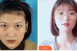 寧波藝星整形美容醫(yī)院肖慶華整形價格表附內(nèi)切祛眼袋案例展示