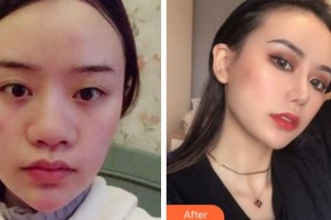 寧波唯格醫(yī)療美容門診部李曉霞整形價格表附鼻中隔軟骨隆鼻案例展示