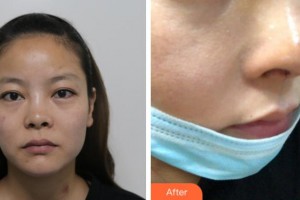 寧波復(fù)大皮膚病?？漆t(yī)院徐暉整形價(jià)格表附隆鼻案例展示