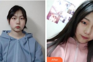 寧波復(fù)大皮膚病?？漆t(yī)院武文帥整形價(jià)格表附埋線提升案例展示