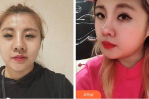 寧波復(fù)大皮膚病專科醫(yī)院王安平整形價(jià)格表附熱瑪吉案例展示