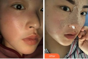 寧波和平博悅美容醫(yī)院汪發(fā)生整形價(jià)格表附鼻部綜合案例展示