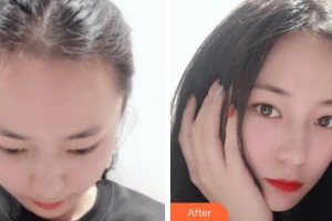 寧波云錦秀醫(yī)療美容診所吳劍華整形價(jià)格表附種植發(fā)際線案例展示