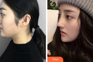 寧波韓美醫(yī)療美容門診部張建波整形價(jià)格表附鼻部綜合案例展示