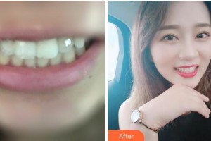 寧波江北口腔醫(yī)院韓春耀整形價(jià)格表附金屬托槽矯正案例展示