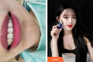 寧波江北口腔醫(yī)院陳镕榕整形價(jià)格表附牙齒隱形矯正案例展示