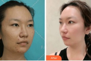 寧波美塑醫(yī)療美容門診部湯朝陽(yáng)整形價(jià)格表附切開雙眼皮案例展示