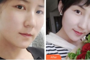 寧波美塑醫(yī)療美容門診部溫志剛整形價(jià)格表附埋線提升案例展示