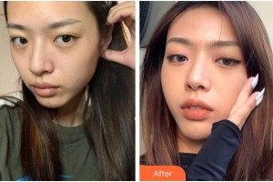 寧波市第六醫(yī)院整形外科周丹亞整形價(jià)格表附埋線提升案例展示