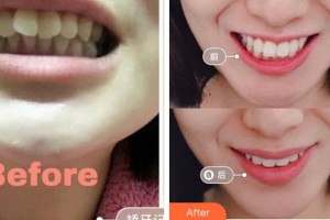 寧波拜博拜爾口腔醫(yī)院林東杰整形價(jià)格表附牙齒隱形矯正案例展示