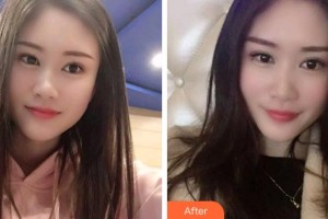 寧波市第六醫(yī)院整形外科胡瑞斌整形價(jià)格表附冷光美白案例展示