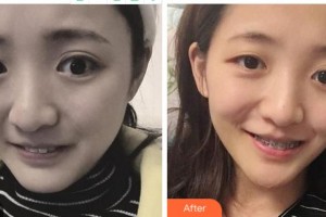 寧波拜博拜爾口腔醫(yī)院吳學(xué)銘整形價(jià)格表附金屬托槽矯正案例展示